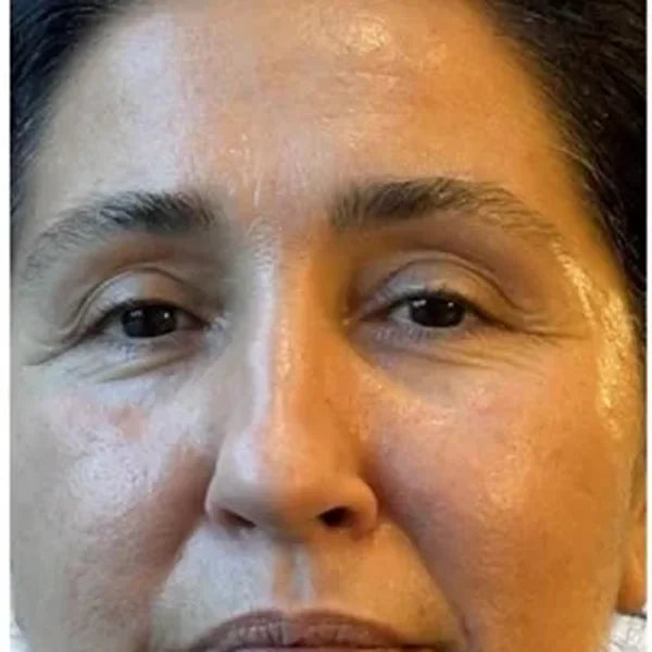 Prije: Korisnica, 52, cijelo lice