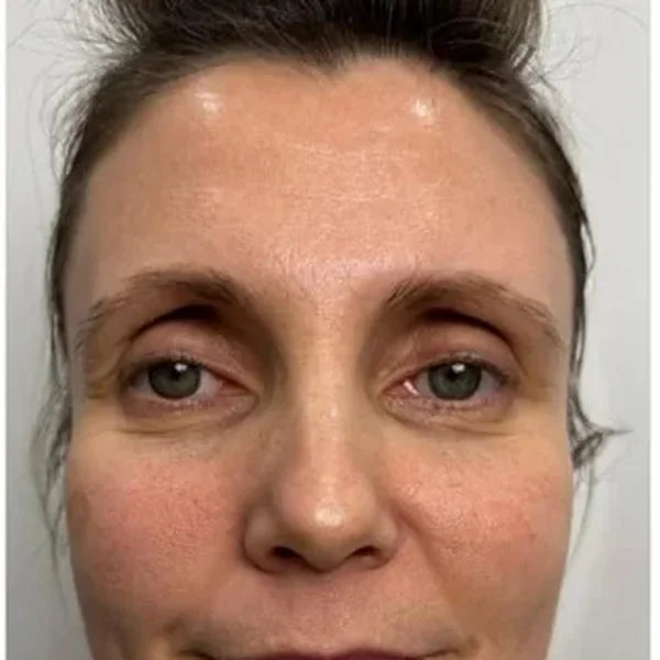 Nakon 2 mjeseca (REMS REVIVE + FACE GYM): Korisnica, 46, cijelo lice