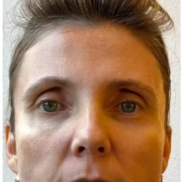 Prije: Korisnica, 46, cijelo lice