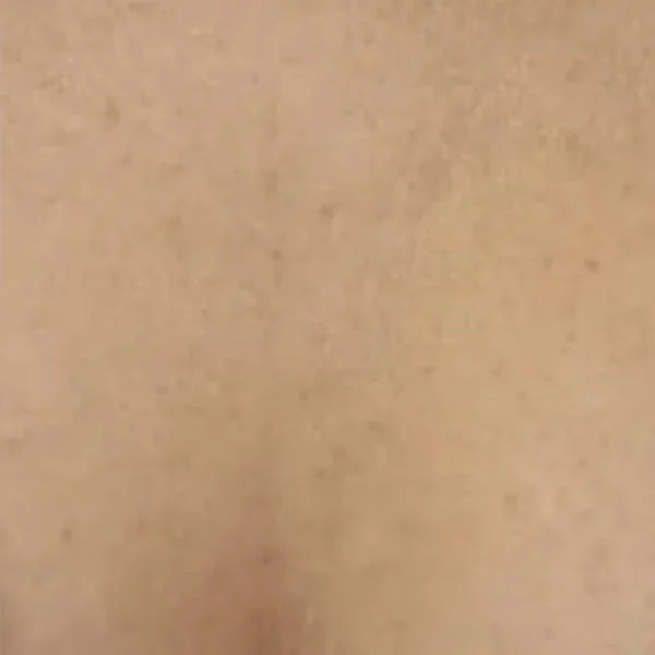 Nakon 1 mjeseca (REMS REVIVE): Korisnica, 47, dekolte