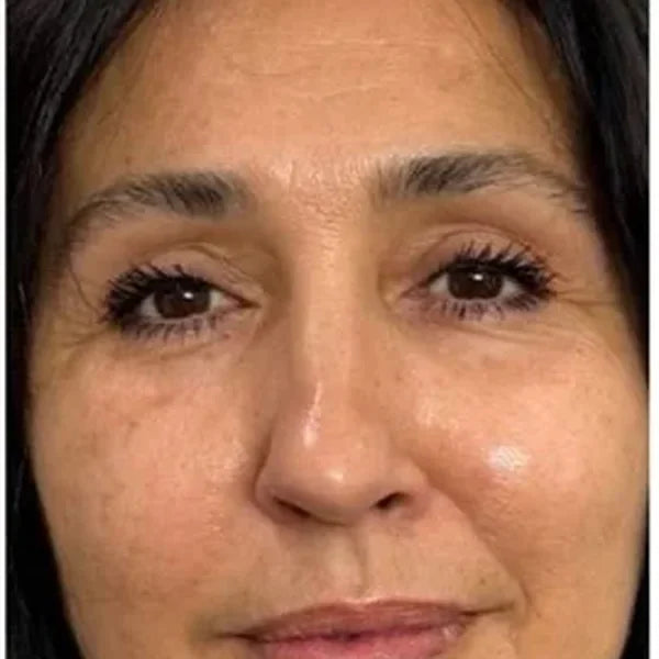 Nakon 1 mjeseca (REMS REVIVE): Korisnica, 52, cijelo lice
